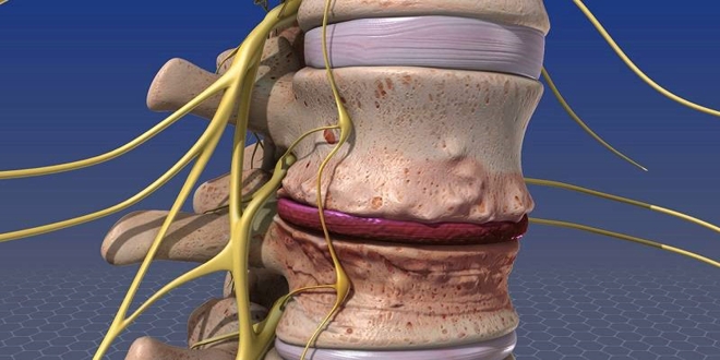 Symptoms and causes of lumbar disc protrusion and herniation 5 ways to fix it 01 - علائم و علت بیرون زدگی و فتق دیسک کمر + 5 روش جا انداختن آن