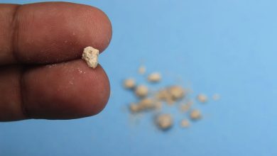 فقط کلیه و صفرا نیست؛ حتی ناف هم سنگ می‌سازد